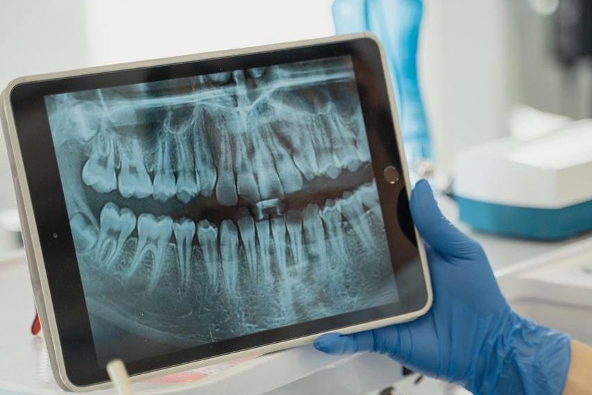 A panoramic dental X-ray reviewed on a tablet
